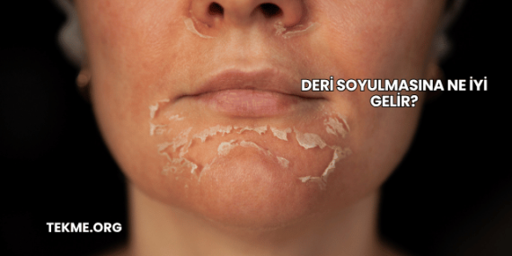 Deri Soyulmasına Ne İyi Gelir?