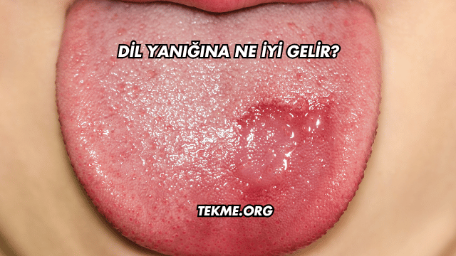 Dil Yanığına Ne İyi Gelir?