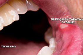 Dilde Çıkan Yaraya Ne İyi Gelir?