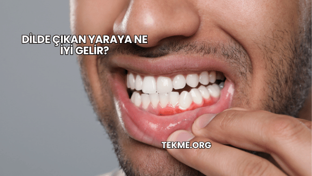 Dilde Çıkan Yaraya Ne İyi Gelir?