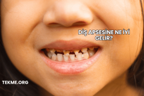 Diş Apsesine Ne İyi Gelir?