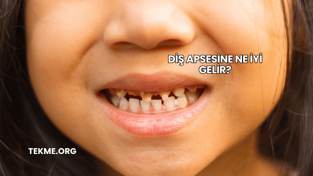 Diş Apsesine Ne İyi Gelir?