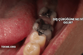 Diş Çürüğüne Ne İyi Gelir?