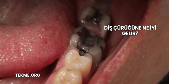 Diş Çürüğüne Ne İyi Gelir?