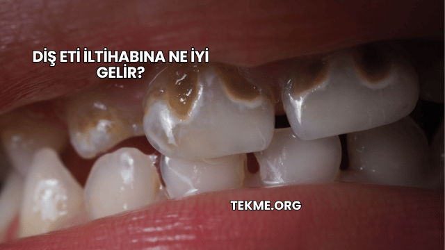 Diş Eti İltihabına Ne İyi Gelir?