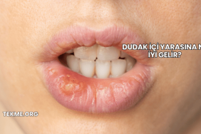 Dudak İçi Yarasına Ne İyi Gelir?
