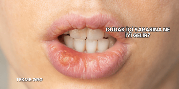 Dudak İçi Yarasına Ne İyi Gelir?