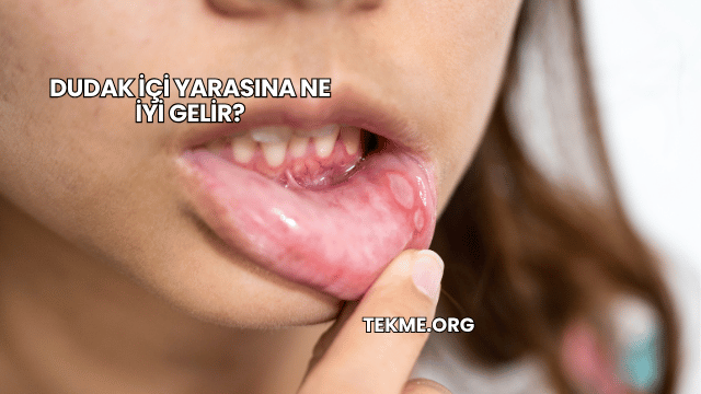 Dudak İçi Yarasına Ne İyi Gelir?