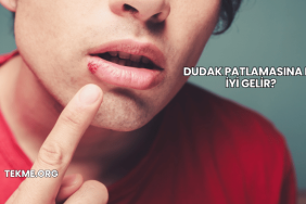 Dudak Patlamasına Ne İyi Gelir?