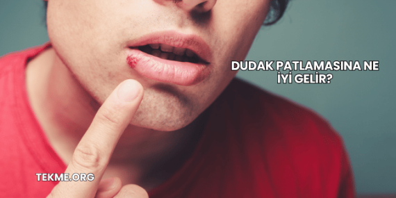 Dudak Patlamasına Ne İyi Gelir?