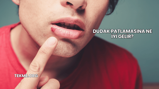 Dudak Patlamasına Ne İyi Gelir?