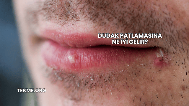 Dudak Patlamasına Ne İyi Gelir?