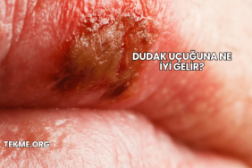 Dudak Uçuğuna Ne İyi Gelir?