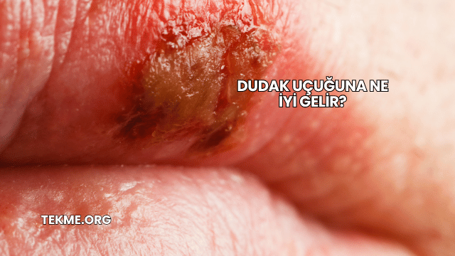Dudak Uçuğuna Ne İyi Gelir?