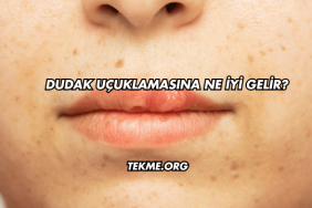 Dudak Uçuklamasına Ne İyi Gelir?