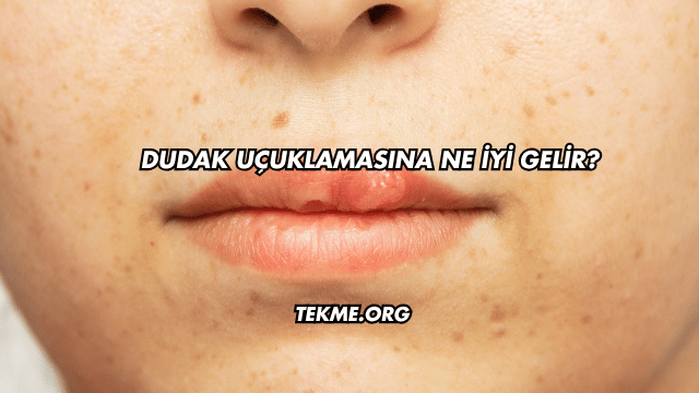 Dudak Uçuklamasına Ne İyi Gelir?