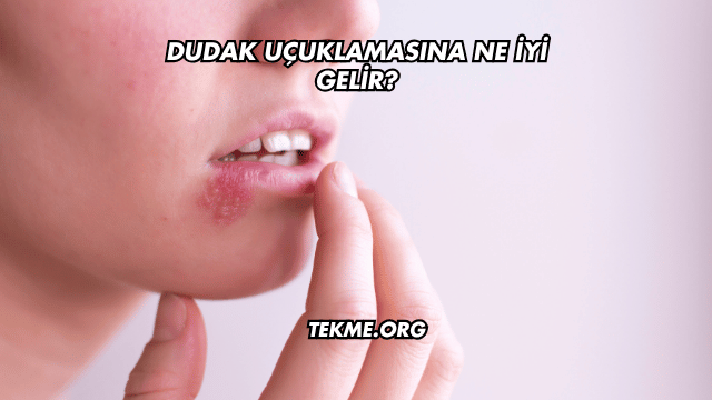 Dudak Uçuklamasına Ne İyi Gelir?