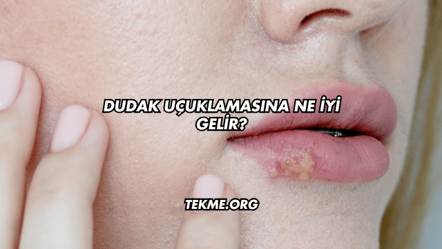 Dudak Uçuklamasına Ne İyi Gelir?