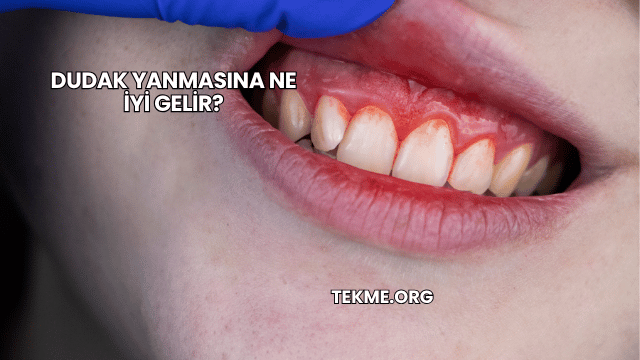 Dudak Yanmasına Ne İyi Gelir?