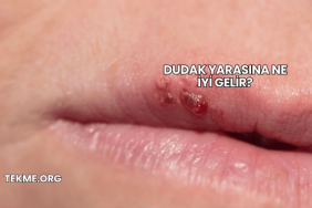 Dudak Yarasına Ne İyi Gelir?