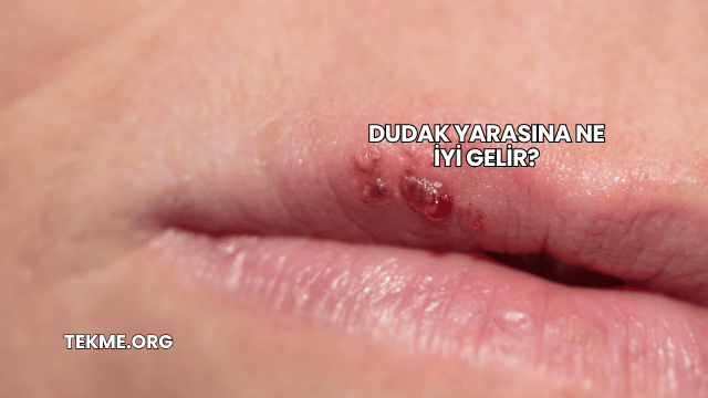 Dudak Yarasına Ne İyi Gelir?