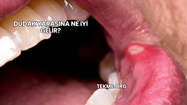 Dudak Yarasına Ne İyi Gelir?