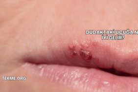 Dudaktaki Uçuğa Ne İyi Gelir?