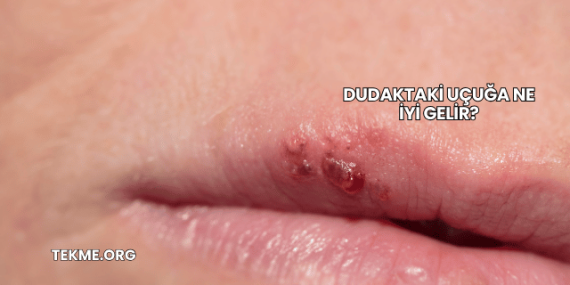 Dudaktaki Uçuğa Ne İyi Gelir?