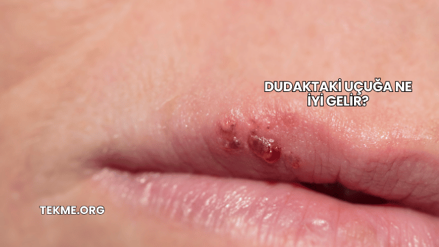 Dudaktaki Uçuğa Ne İyi Gelir?