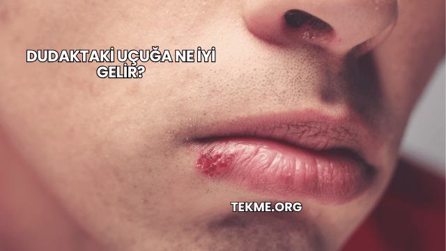 Dudaktaki Uçuğa Ne İyi Gelir?