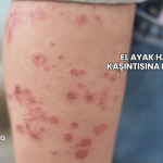 El Ayak Hastalığı Kaşıntısına Ne İyi Gelir?