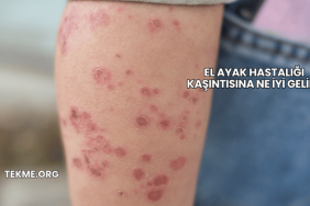 El Ayak Hastalığı Kaşıntısına Ne İyi Gelir?