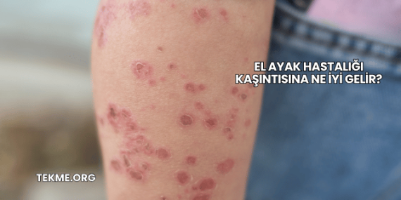 El Ayak Hastalığı Kaşıntısına Ne İyi Gelir?