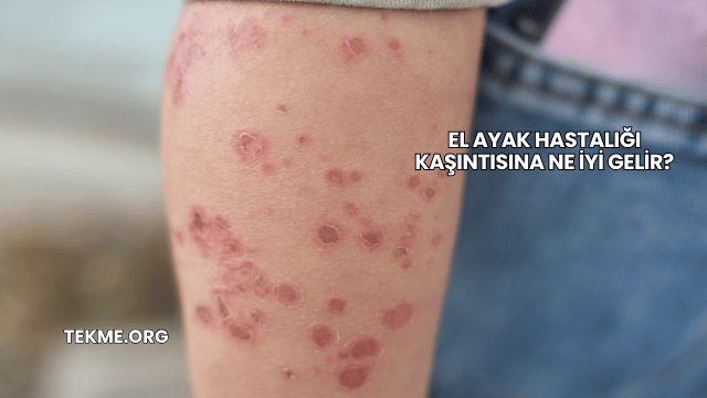 El Ayak Hastalığı Kaşıntısına Ne İyi Gelir?