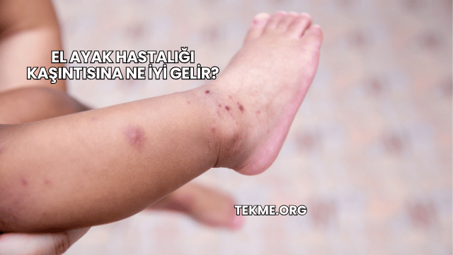 El Ayak Hastalığı Kaşıntısına Ne İyi Gelir?