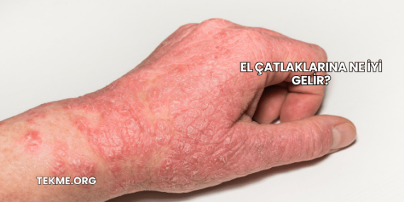 El Çatlaklarına Ne İyi Gelir?