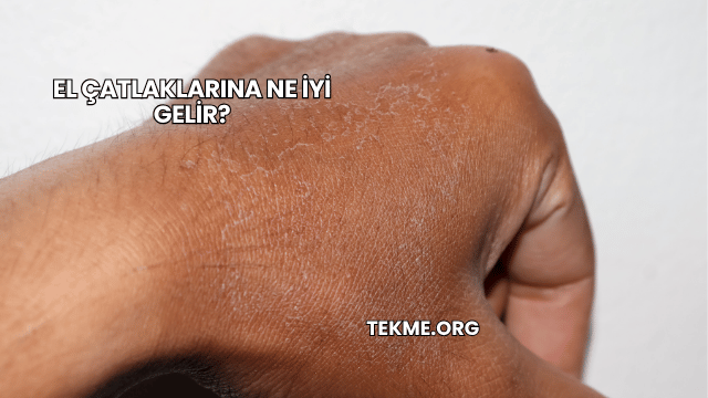 El Çatlaklarına Ne İyi Gelir?