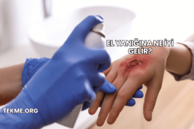 El Yanığına Ne İyi Gelir?
