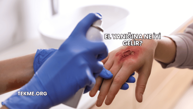 El Yanığına Ne İyi Gelir?