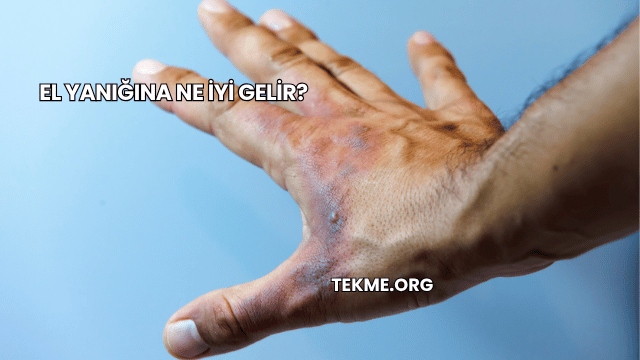 El Yanığına Ne İyi Gelir?