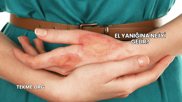 El Yanığına Ne İyi Gelir?