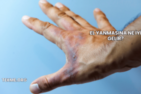 El Yanmasına Ne İyi Gelir?