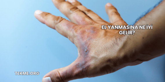 El Yanmasına Ne İyi Gelir?