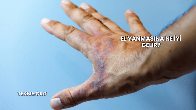 El Yanmasına Ne İyi Gelir?