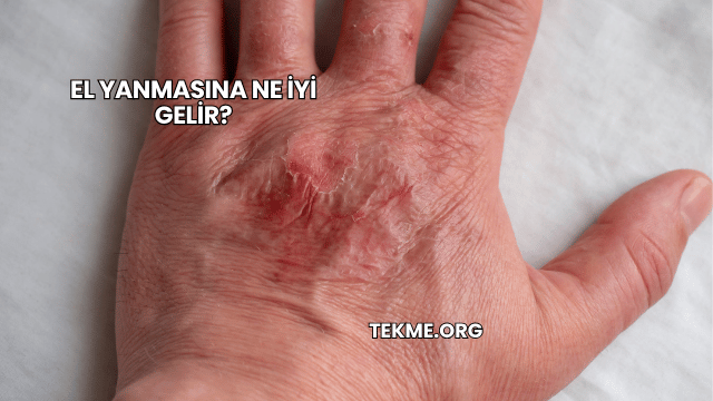El Yanmasına Ne İyi Gelir?