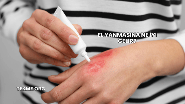 El Yanmasına Ne İyi Gelir?