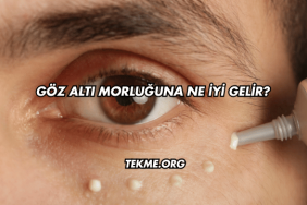 Göz Altı Morluğuna Ne İyi Gelir?
