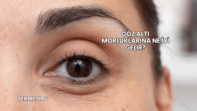 Göz Altı Morluklarına Ne İyi Gelir?