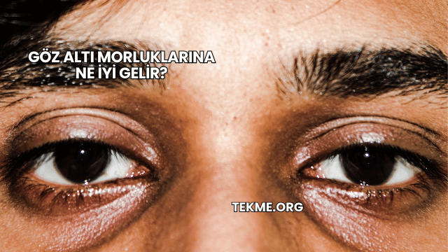 Göz Altı Morluklarına Ne İyi Gelir?