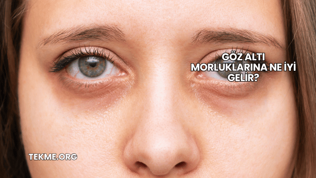 Göz Altı Morluklarına Ne İyi Gelir?